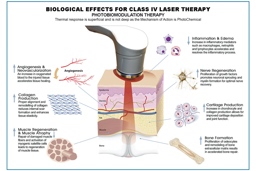 Class IV Laser