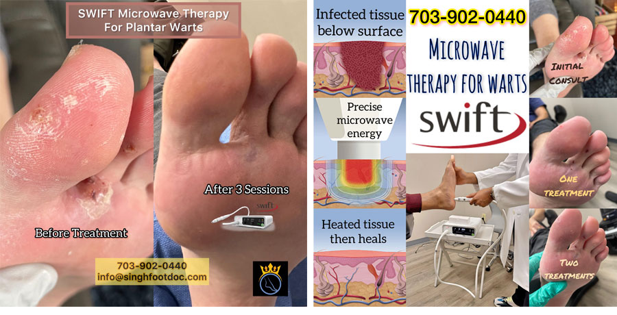 SWIFT Microwave Therapy for Plantar Warts