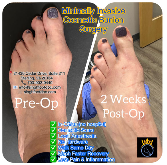 MIFAS Before and After Cosmetic Bunion Surgery